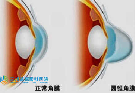 圓錐角膜怎樣？