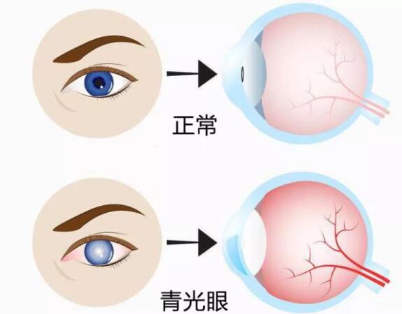 第17個青光眼周｜共管慢病青光眼，留得光明恒久遠